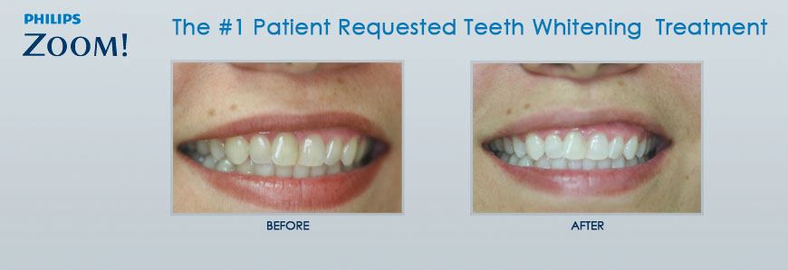 Nutley NJ ZOOM Teeth Whitening